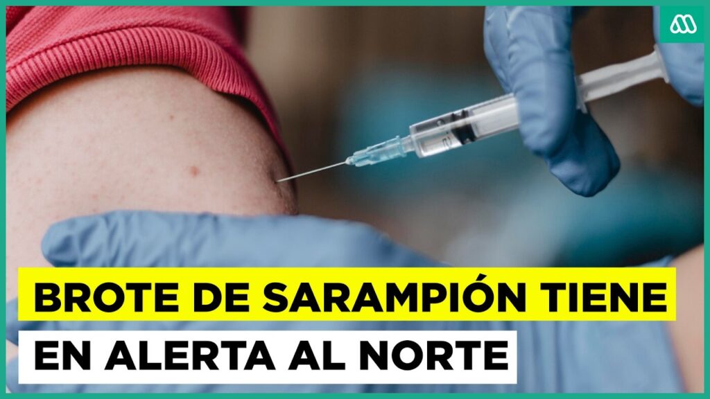 Nuevo brote de sarampión mantiene en alerta al norte de Chile