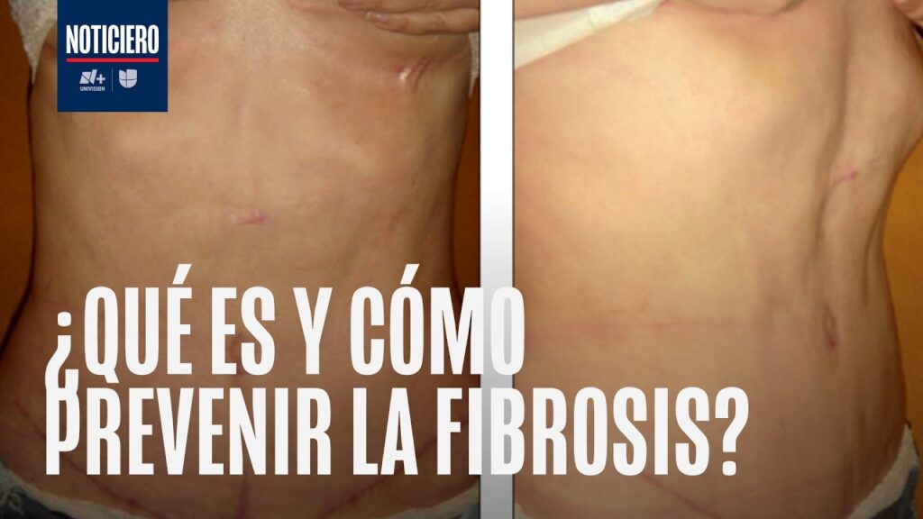 ¿Tu cirugía estética se ve extraña? Podría ser fibrosis
